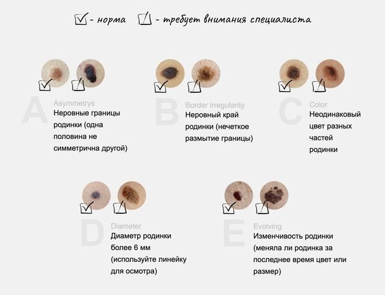 Как отличить обычную родинку от меланомы?